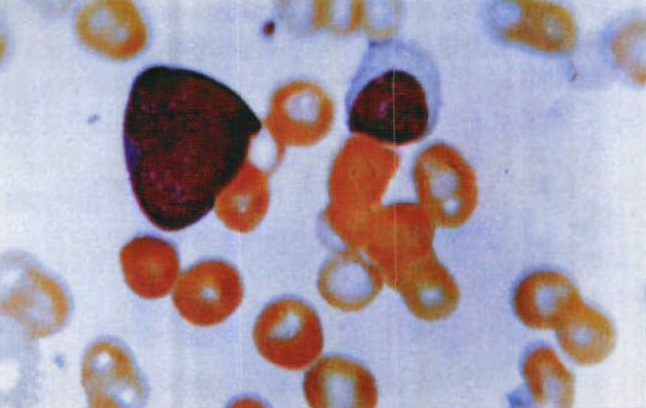 图4-14 淋巴肉瘤血像